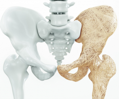 OSTEOPOROSE E EXERC�CIO F�SICO